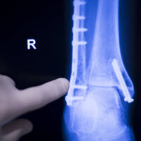 X-Ray3 X-Ray3