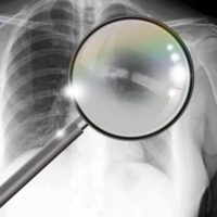 InjuredRibs2 InjuredRibs2